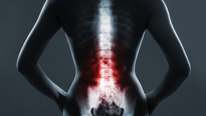 Lumbar Spine Fusion