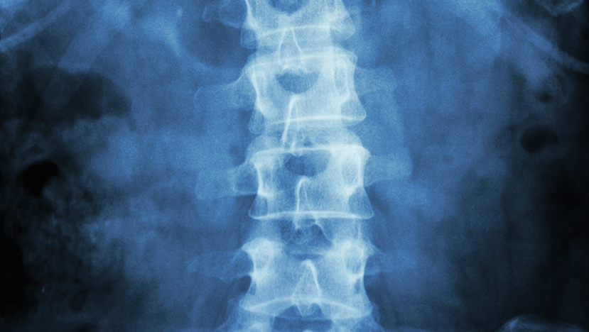 Spinal Disc Replacement