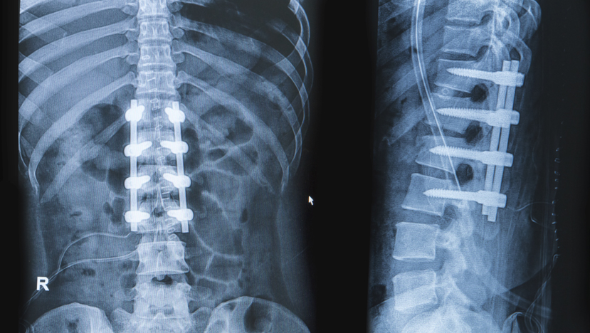 Spinal Fusion Surgery