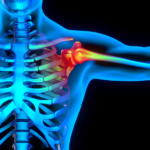 A glowing blue body with the skeleton showing through with glowing red where shoulder pain is occurring from a shoulder injury