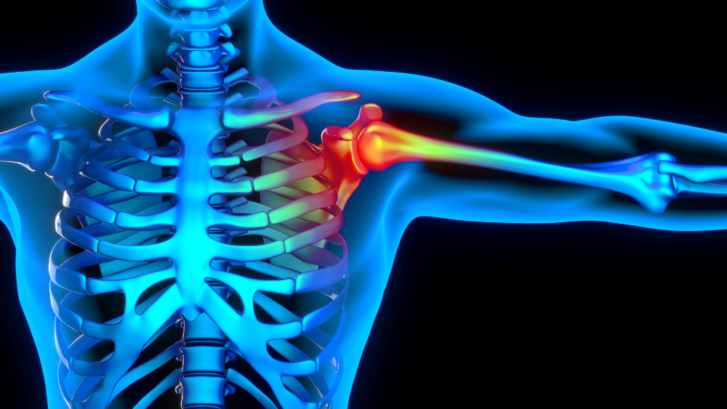 A glowing blue body with the skeleton showing through with glowing red where shoulder pain is occurring from a shoulder injury
