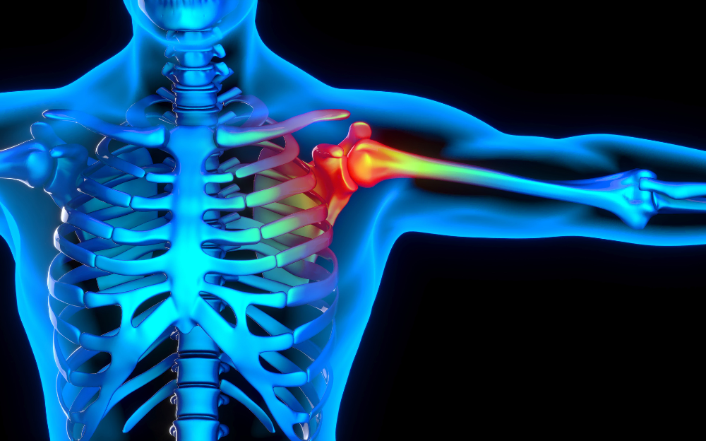 A glowing blue body with the skeleton showing through with glowing red where shoulder pain is occurring from a shoulder injury
